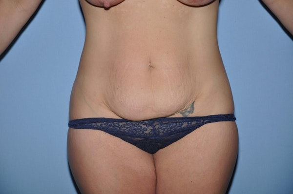 Tummy Tuck Before & After Gallery - Patient 9568199 - Image 1