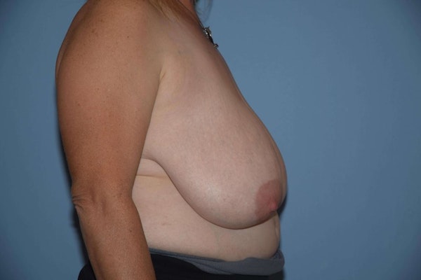 Breast Reduction Before & After Gallery - Patient 9568207 - Image 5