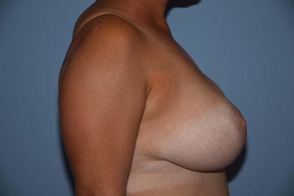 Breast Reduction Before & After Gallery - Patient 9568207 - Image 6