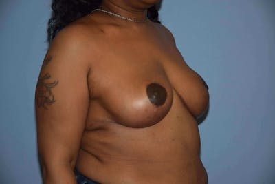 Breast Reduction Before & After Gallery - Patient 9568215 - Image 4