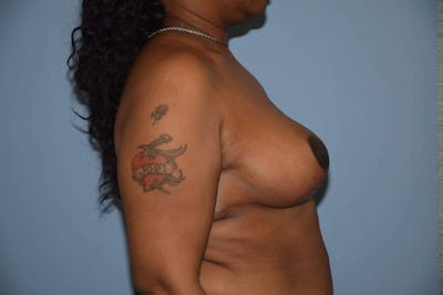 Breast Reduction Before & After Gallery - Patient 9568215 - Image 6
