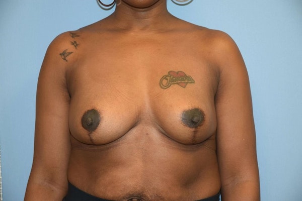 Breast Reduction Before & After Gallery - Patient 9568217 - Image 2