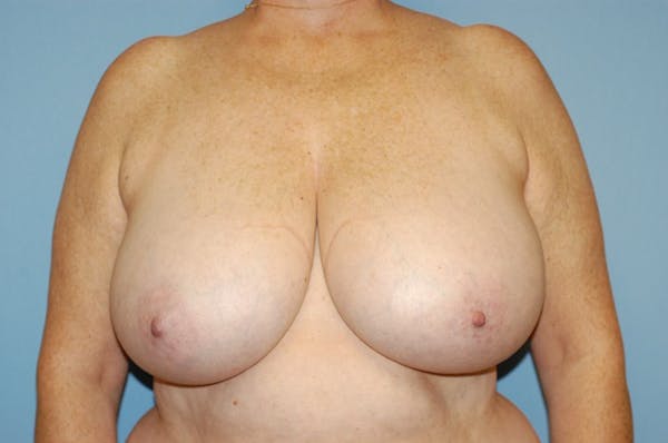 Breast Reduction Gallery - Patient 9568224 - Image 1