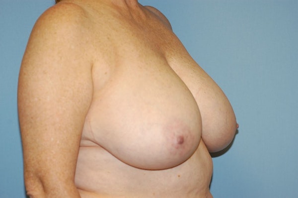Breast Reduction Before & After Gallery - Patient 9568224 - Image 3