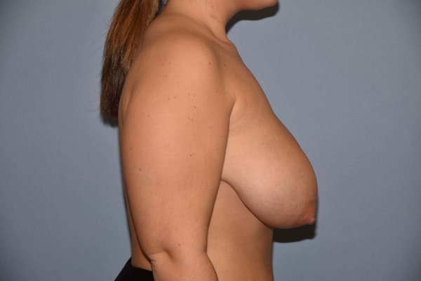 Breast Reduction Before & After Gallery - Patient 9568255 - Image 5