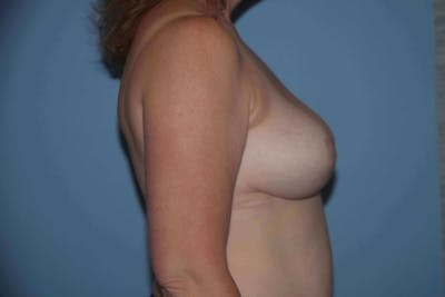 Breast Reduction Before & After Gallery - Patient 9568275 - Image 6