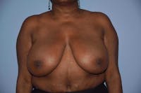 Breast Reduction Before & After Gallery - Patient 9568279 - Image 1