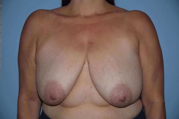 Breast Reduction Before & After Gallery - Patient 9568281 - Image 1