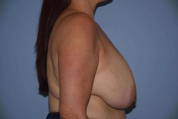 Breast Reduction Before & After Gallery - Patient 9568281 - Image 3