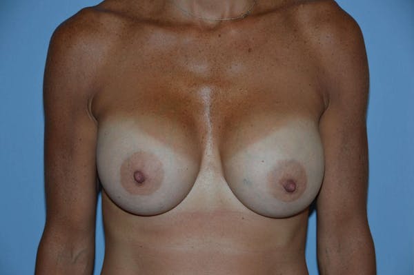 Breast Augmentation  Before & After Gallery - Patient 9568299 - Image 2