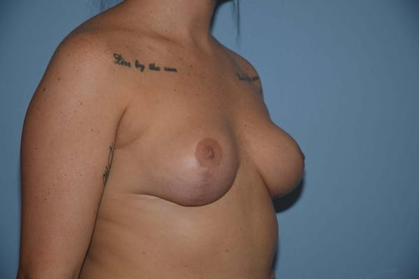 Breast Reduction Gallery - Patient 14281647 - Image 4