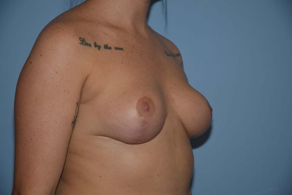 Breast Reduction Before & After Gallery - Patient 14281647 - Image 4