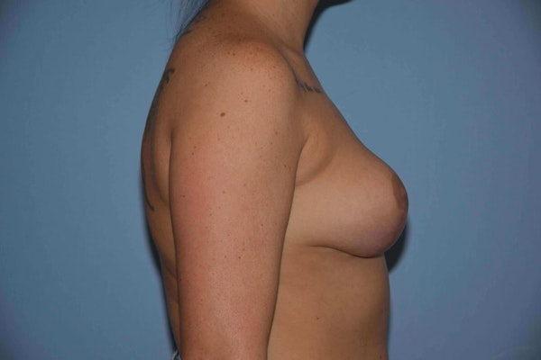 Breast Reduction Before & After Gallery - Patient 14281647 - Image 6