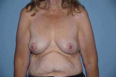 Breast Reduction Before & After Gallery - Patient 9568303 - Image 2