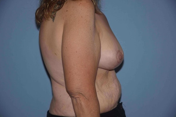 Breast Reduction Before & After Gallery - Patient 9568303 - Image 6