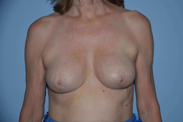 Breast Reduction Before & After Gallery - Patient 9568306 - Image 2