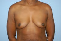 Breast Augmentation  Gallery - Patient 9568309 - Image 1