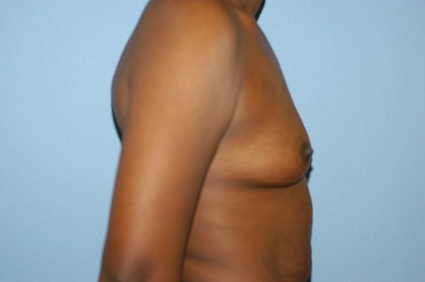 Breast Augmentation  Before & After Gallery - Patient 9568309 - Image 5