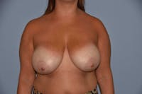 Breast Reduction Before & After Gallery - Patient 9568313 - Image 1