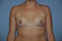 Breast Augmentation  Gallery - Patient 9568316 - Image 1