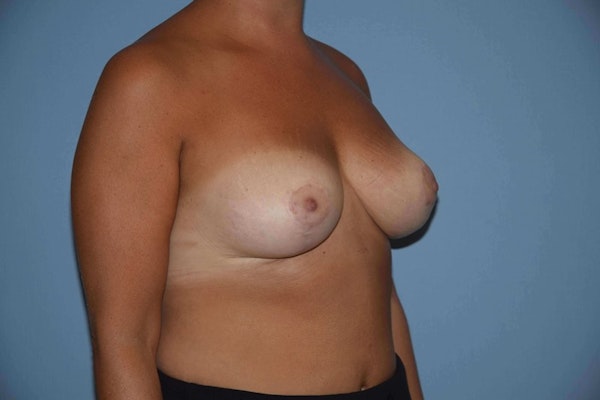 Breast Reduction Before & After Gallery - Patient 9568313 - Image 4