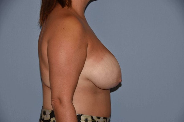 Breast Reduction Before & After Gallery - Patient 9568313 - Image 5