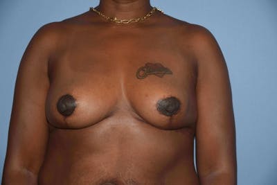 Breast Reduction Before & After Gallery - Patient 9568317 - Image 2
