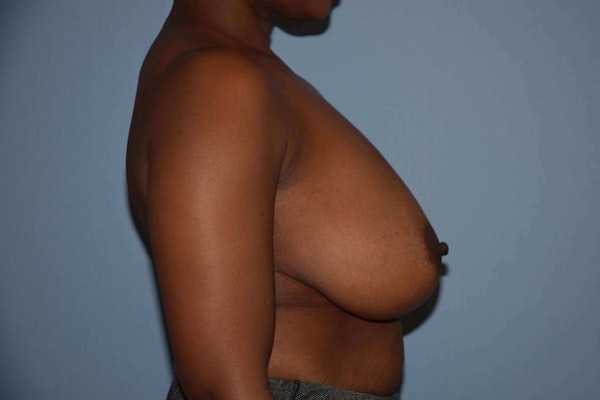 Breast Reduction Before & After Gallery - Patient 9568317 - Image 5