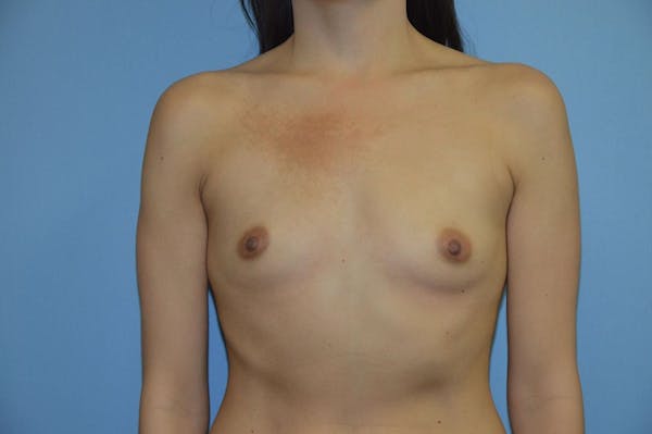 Breast Augmentation  Gallery - Patient 9568348 - Image 1