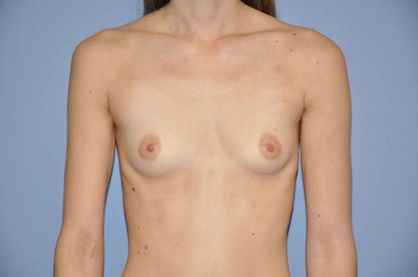 Breast Augmentation  Gallery - Patient 9568350 - Image 1