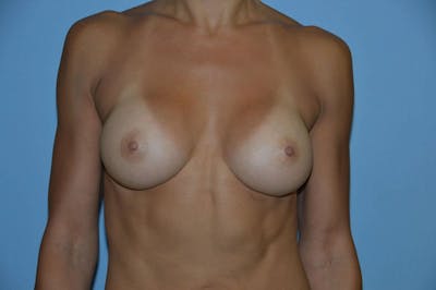 Breast Augmentation  Before & After Gallery - Patient 9568355 - Image 2