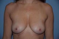 Breast Augmentation  Gallery - Patient 9568359 - Image 1