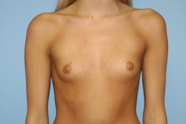 Breast Augmentation  Before & After Gallery - Patient 9568367 - Image 1