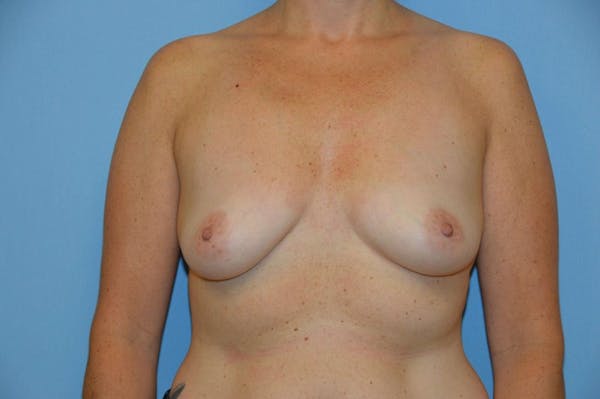 Breast Augmentation  Gallery - Patient 9582100 - Image 1