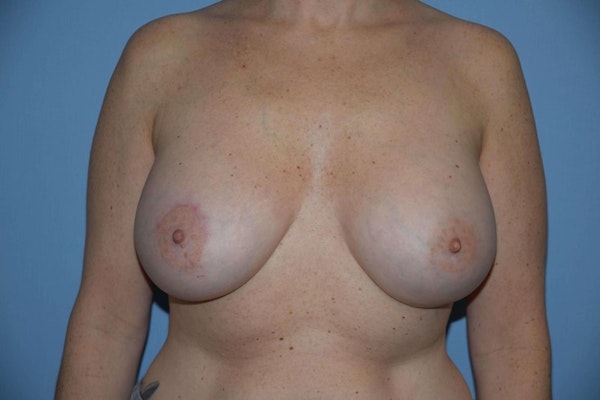 Breast Augmentation  Before & After Gallery - Patient 9582100 - Image 2
