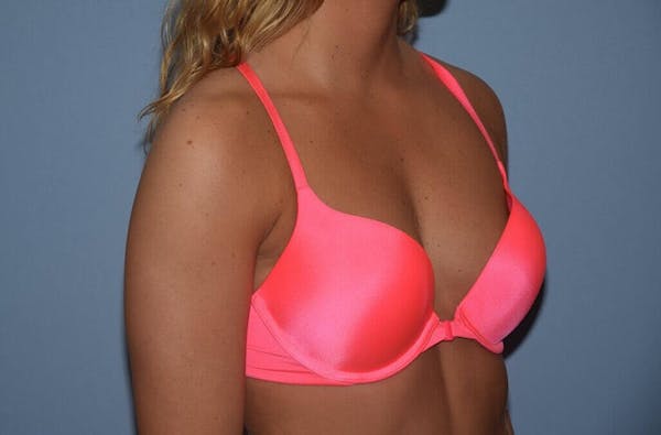 Breast Augmentation  Gallery - Patient 9582104 - Image 9