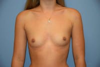 Breast Augmentation  Gallery - Patient 9582111 - Image 1