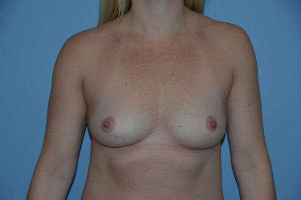 Breast Augmentation  Gallery - Patient 9582117 - Image 1