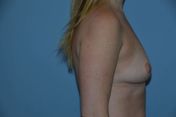 Breast Augmentation  Before & After Gallery - Patient 9582117 - Image 5