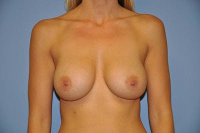 Breast Augmentation  Before & After Gallery - Patient 9582128 - Image 2