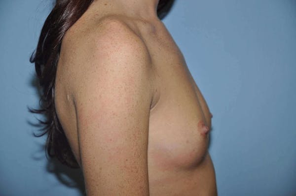 Breast Augmentation  Gallery - Patient 9582129 - Image 5