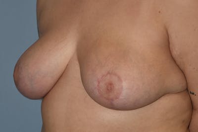 Breast Reduction Before & After Gallery - Patient 15930314 - Image 6