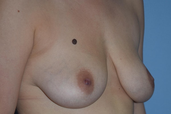 Breast Augmentation Lift Before & After Gallery - Patient 16480556 - Image 3