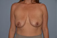 Breast Augmentation Lift Before & After Gallery - Patient 16480557 - Image 1