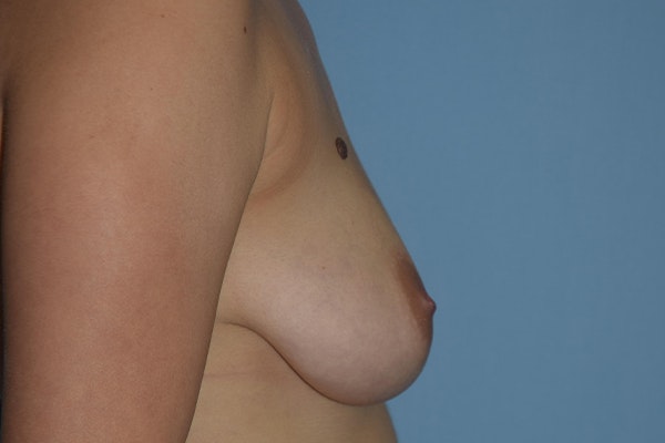 Breast Augmentation Lift Before & After Gallery - Patient 16480556 - Image 5
