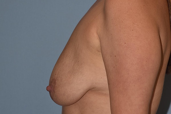 Breast Augmentation Lift Before & After Gallery - Patient 16480557 - Image 5