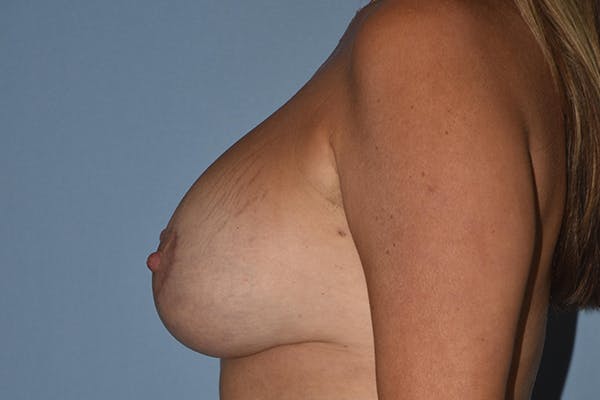 Breast Augmentation Lift Gallery - Patient 16480557 - Image 6