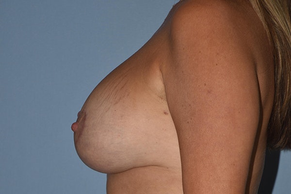 Breast Augmentation Lift Before & After Gallery - Patient 16480557 - Image 6