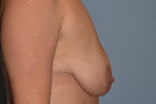 Breast Augmentation Lift Before & After Gallery - Patient 16480557 - Image 9