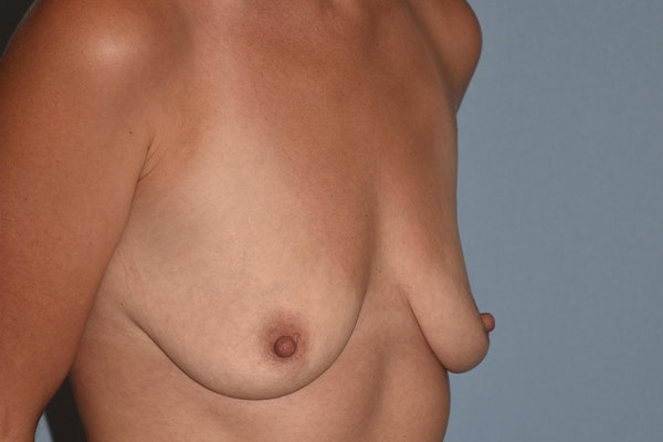 Breast Augmentation Lift Before & After Gallery - Patient 16480559 - Image 3